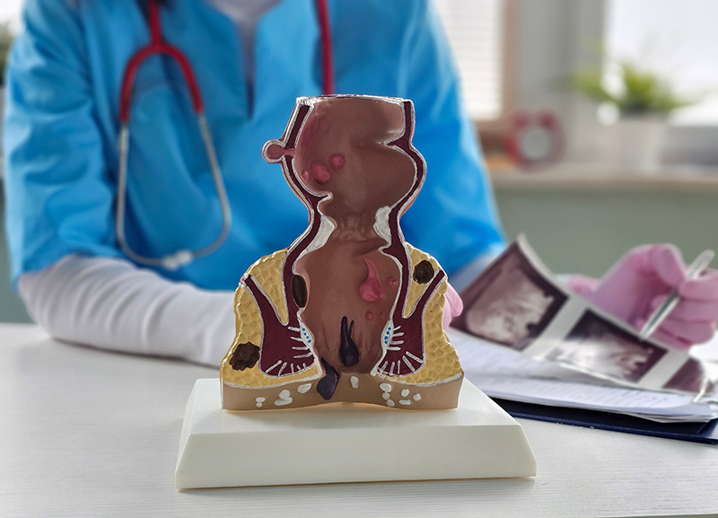 Doctor with a rectum anatomy model during a consultation