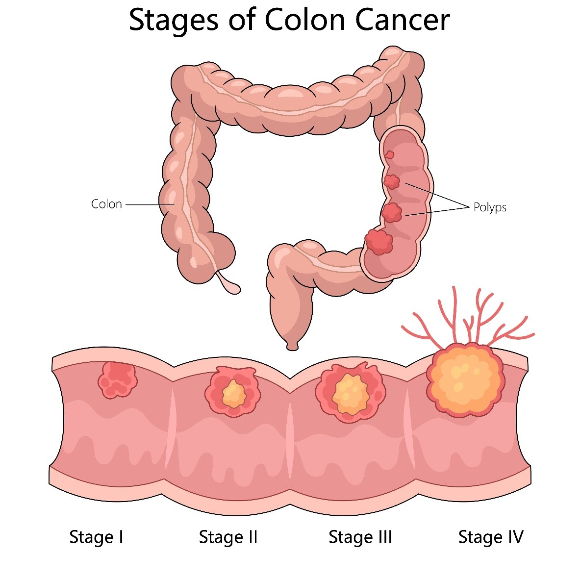 Colorectal cancer stages illustration